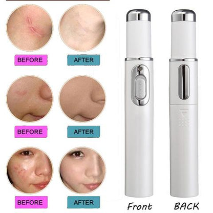 Blue Light Therapy Acne Laser Pen - Scar & Wrinkle Removal Device